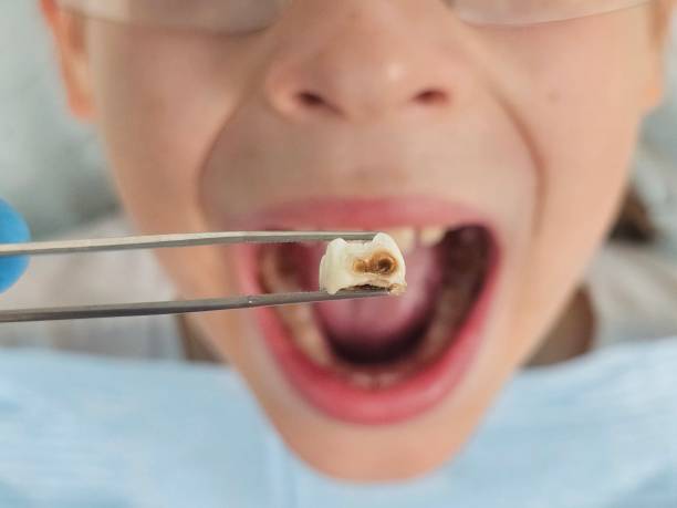 Best Emergency Dental Extractions in Edinburg, TX